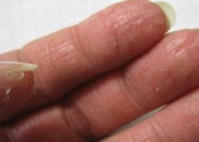 Почему появились трещины на ногтях рук — фото, причины и лечение